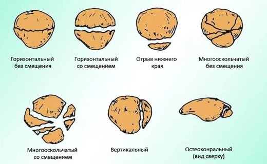 Типы переломов надколенника
