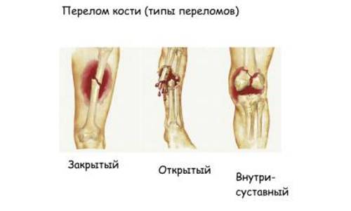 Типы переломов