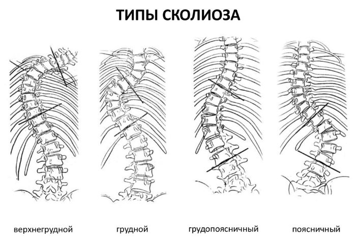 Типы сколиоза по отделам