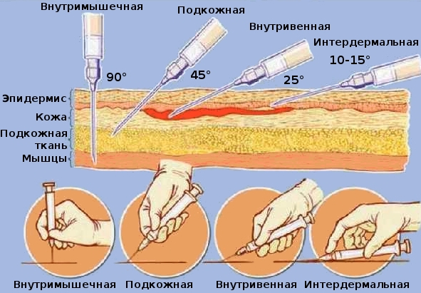 Типы введения инъекций