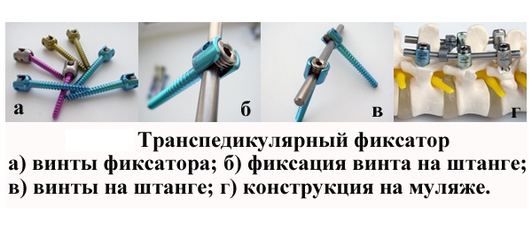 Транспедикулярный фиксатор