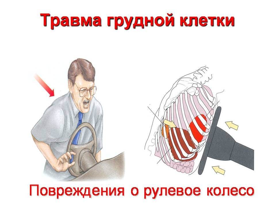 Травма грудной клетки