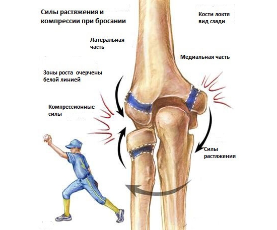 Растяжение локтя при чрезмерных нагрузках