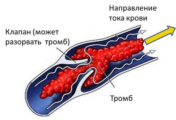 Тромбоз