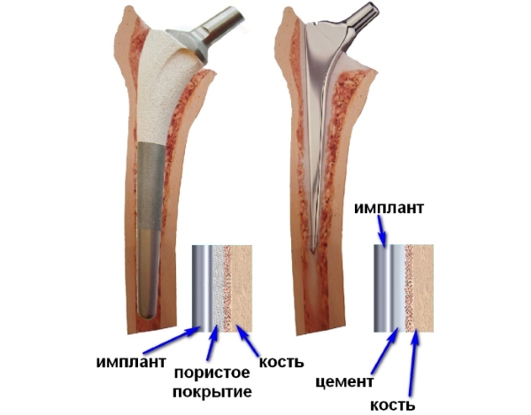Цементный и бесцементный протез