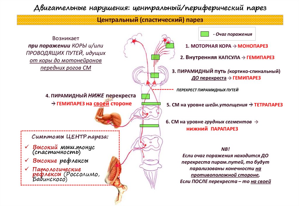 Центральный спастический парез