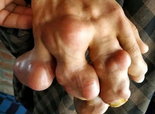 Тяжелый случай подагры