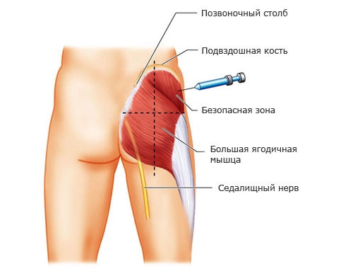 Внутримышечный укол