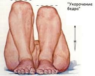 Укорочение ноги при переломе шейки бедра