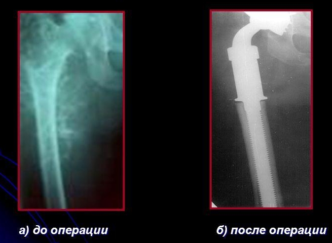 Установка эндопротезов в зоне удаления обширной хондросаркомы