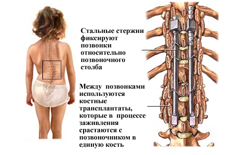 Установка стальных стержней