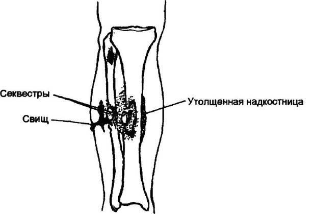 Утолщение надкостницы и свищ
