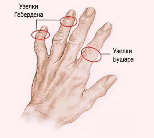 Узелки Гебердена и узелки Бушара