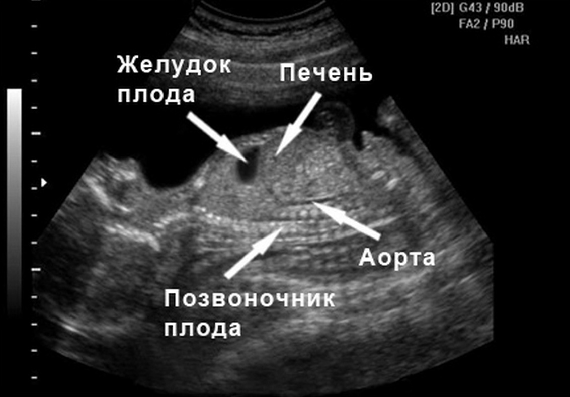 УЗИ плода