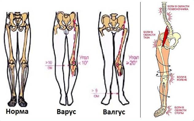 Вальгусное искривление коленей