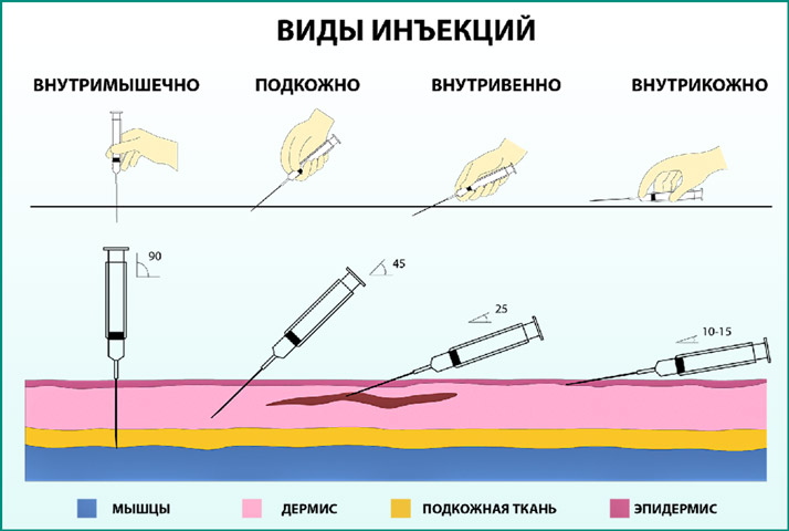 Варианты введения инъекций