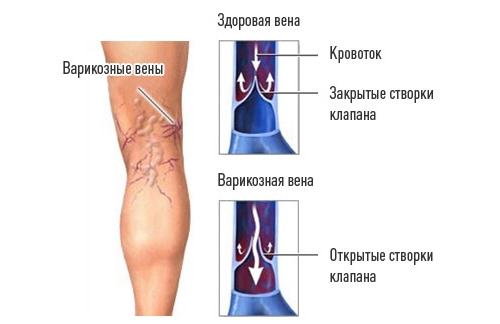 Варикоз