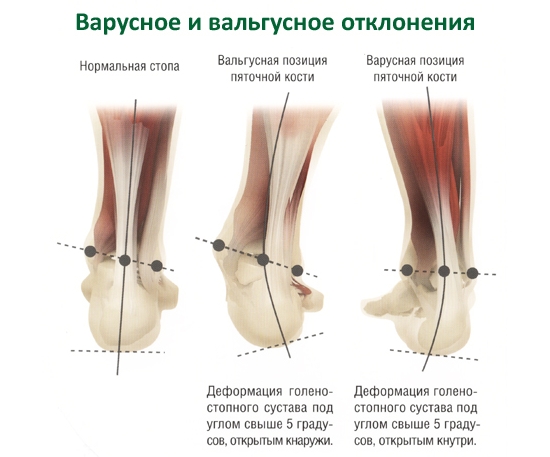 Варусное и вальгусное отклонение стопы