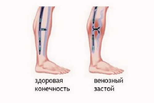 Венозный стаз