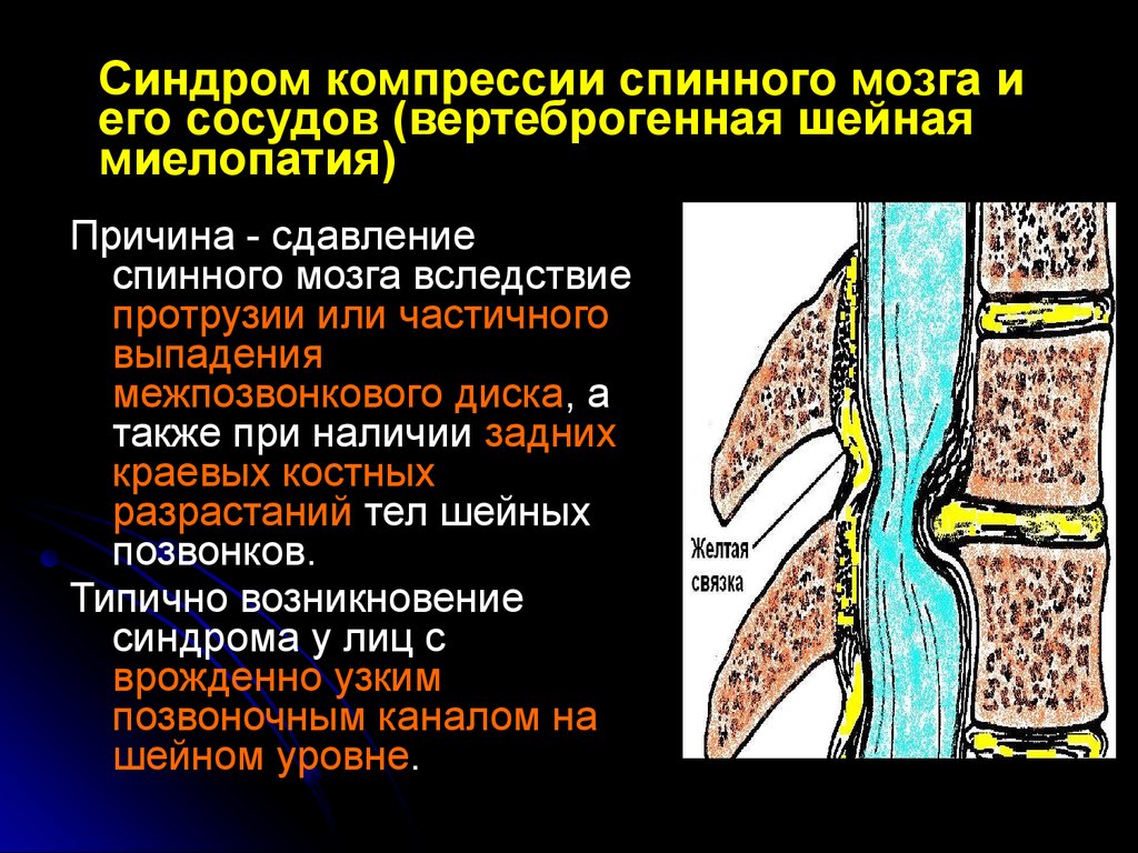 Вертеброгенная цервикалгия