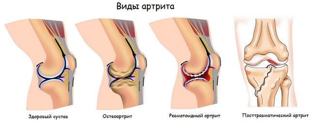 Виды артрита