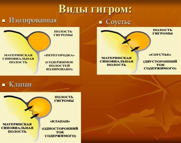 Виды гигром
