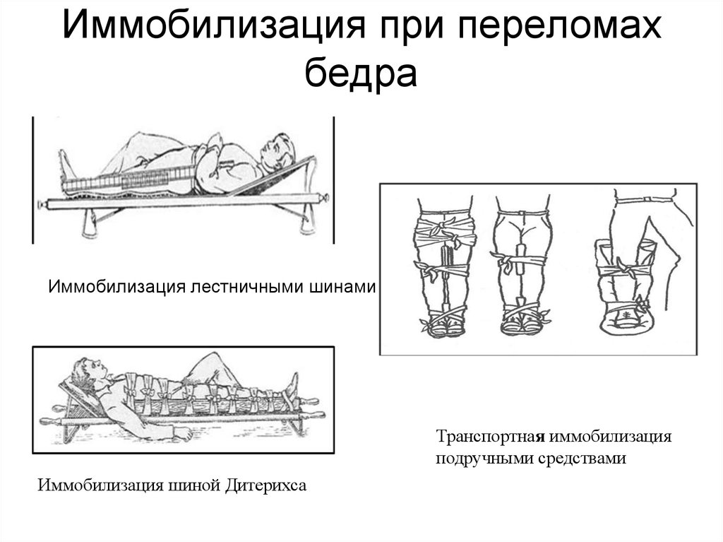Виды иммобилизации при переломах бедра