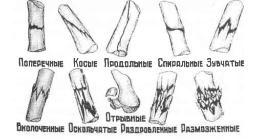 Виды переломов