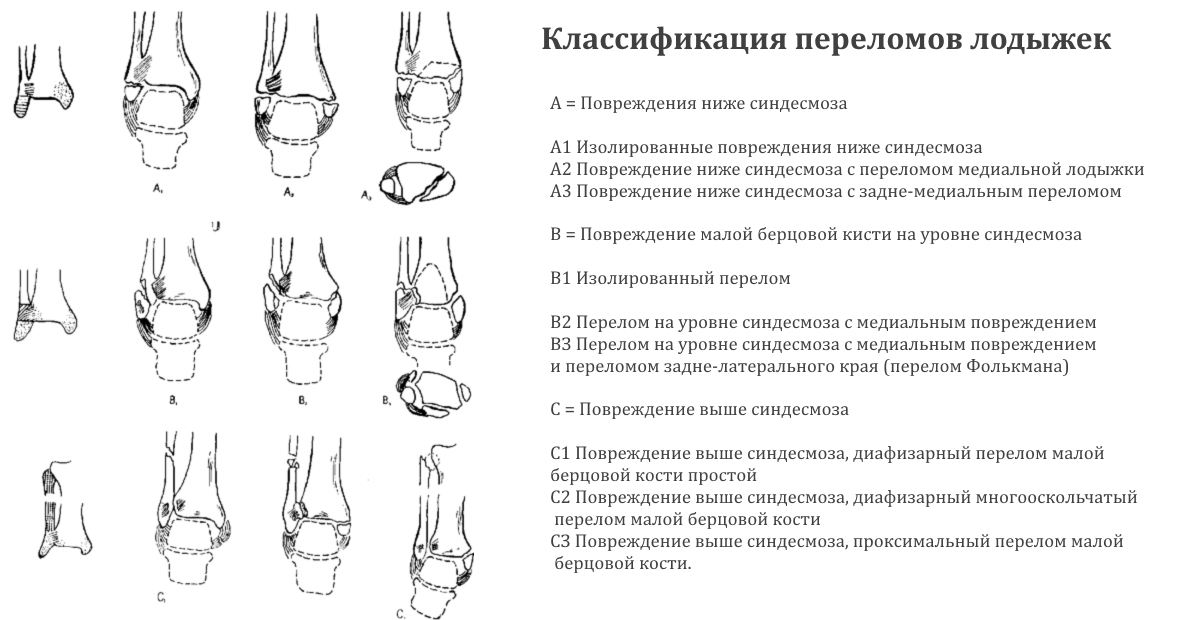 Классификация переломов