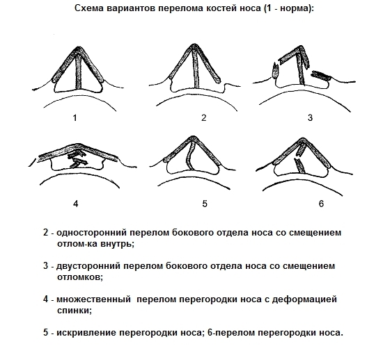 Виды переломов носа