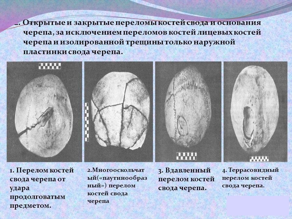 Виды переломов основания и свода черепа