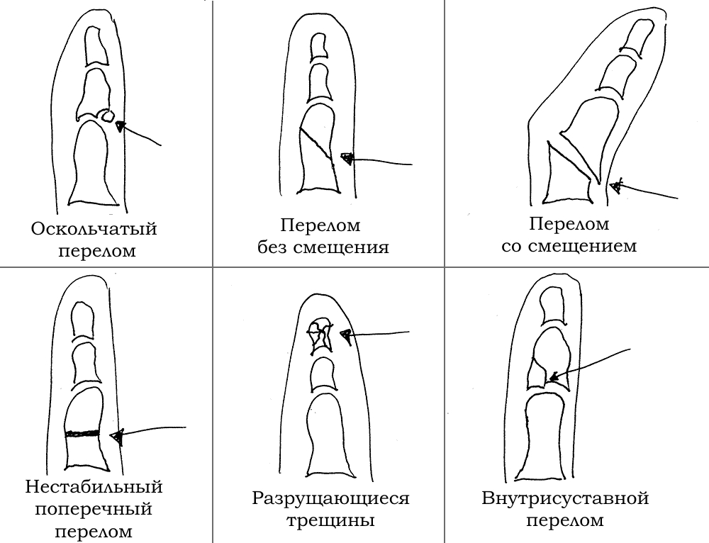 Виды переломов фалангов пальцев