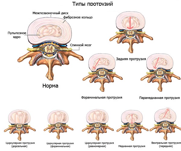 Типы протрузии