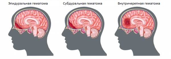 Виды внутричерепных гематом
