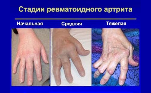 Визуальные стадии ревматоидного артрита