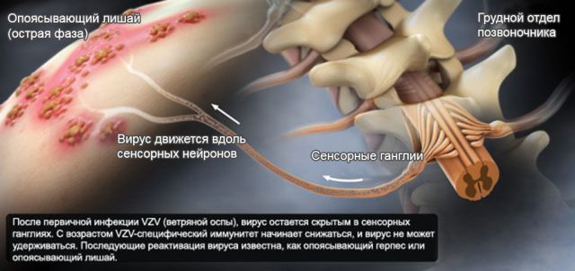 Воспаление нерва на фоне опоясывающего лишая