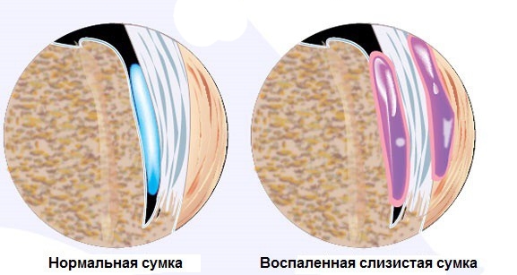 Бурсит - воспаление слизистой сумки