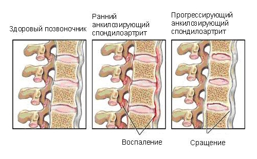 Воспалительный процесс и сращение позвонков при спондилоартрите