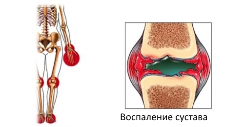 Воспаление сустава