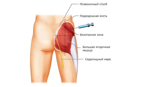 Введение препарата внутримышечно