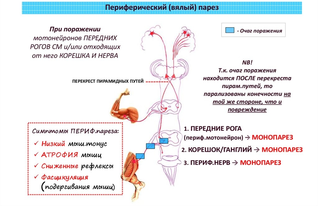 Периферический или вялый парез