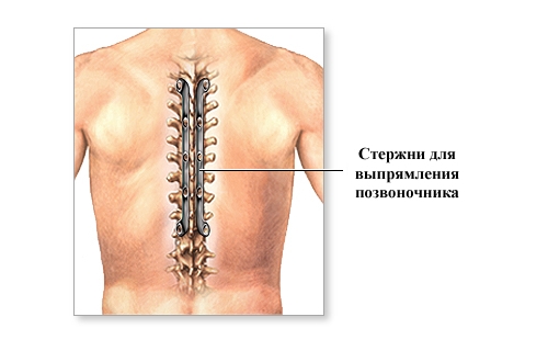 Выпрямление кифоза стержнями
