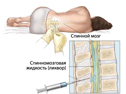 Вытекание спинномозговой жидкости