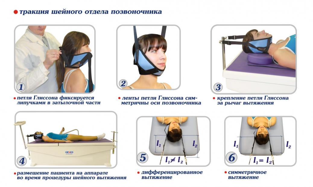 Вытяжение шейного отдела позвоночника