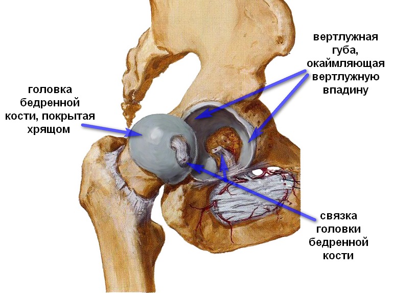 Вывих бедренной кости