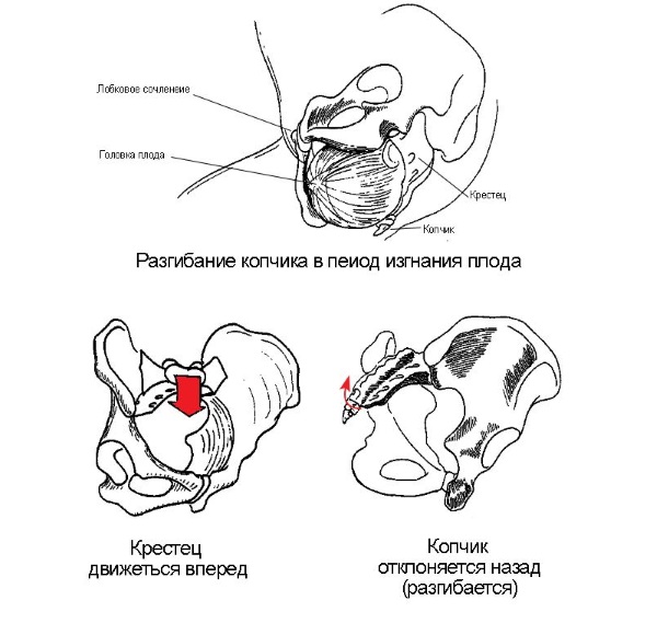 Вывих копчика при родах