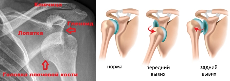 Вывих плеча