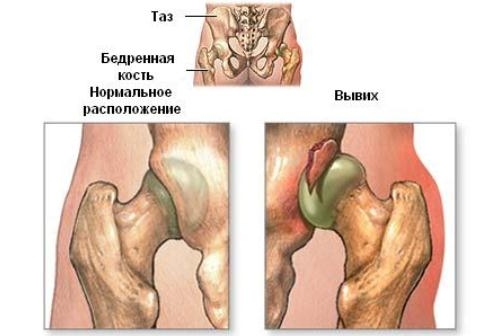 Вывих тазобедренного сустава