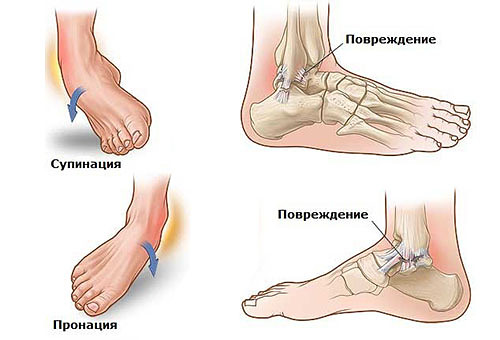 Вывих внутрь и наружу