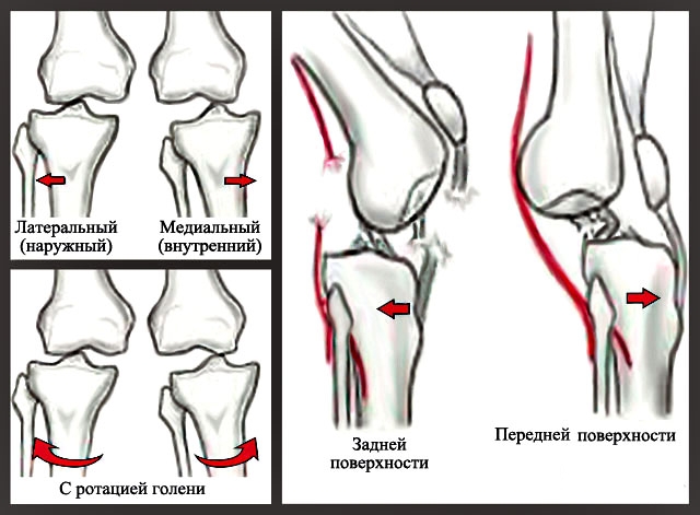Виды вывихов голени
